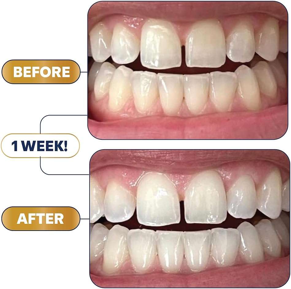 Lumineux 2-in-1 Whitening Pen Enamel Safe and Clinically Proven to Whiten Without The Sensitivity - Removes Coffee, Tea, and Smoking Stains - Image 9