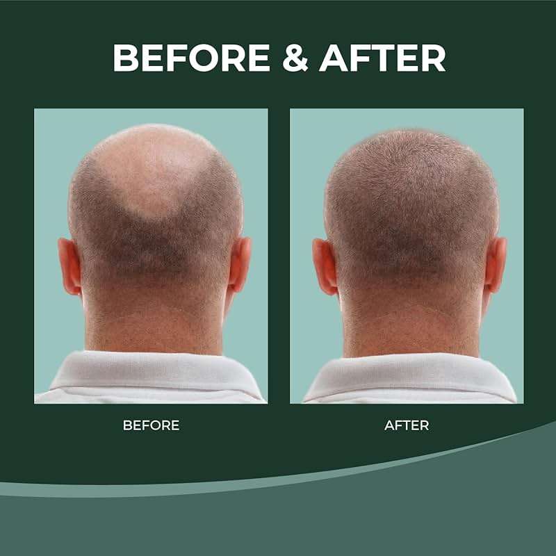 Thik&Fix Hair Growth Supplement - Thickening Powder for Fuller Hair, Reduces Hair Loss for Women and Men, Supports Natural Growth - Image 5