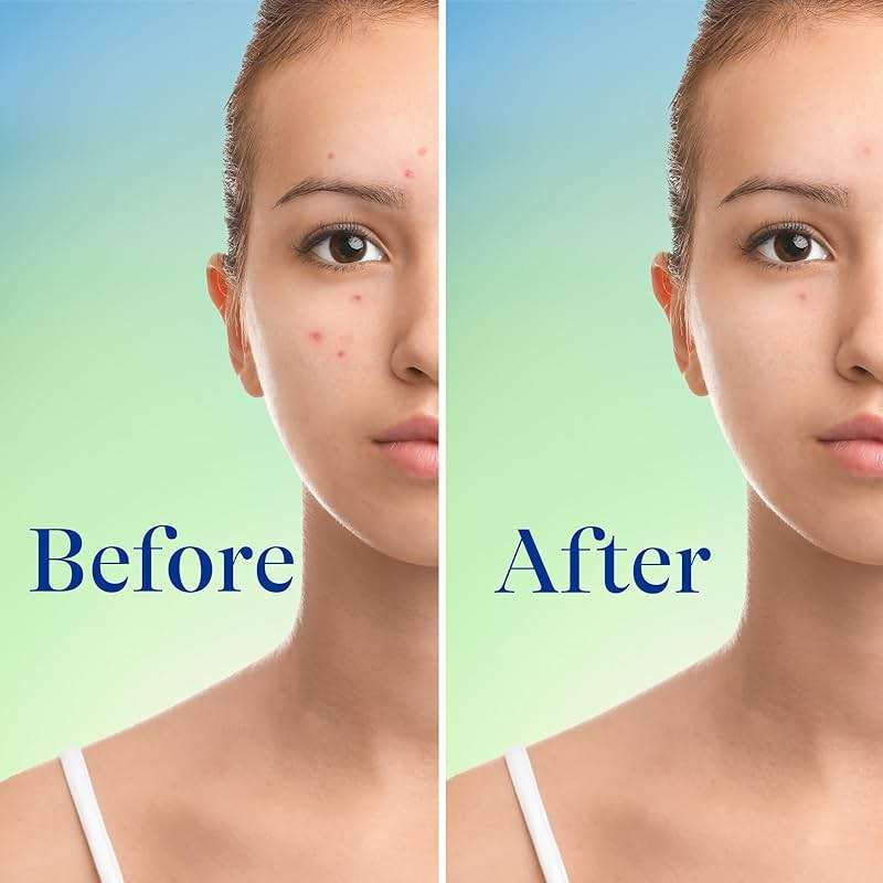 Differin Acne Face Wash with 10% Benzoyl Peroxide, Maximum Strength OTC Acne Foaming Cleanser, Fast Acting Acne Treatment for Face and Body, 5 oz. - Image 5