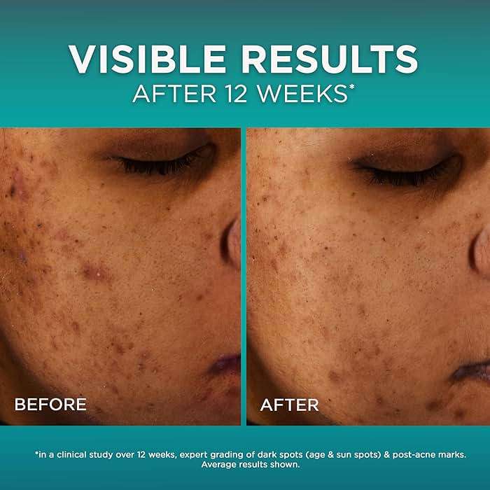 L’Oréal Paris Bright Reveal 12% [Niacinamide + Amino Sulfonic + Ferulic] Dark Spot Serum 1oz + Moisturizer Sample - Image 4
