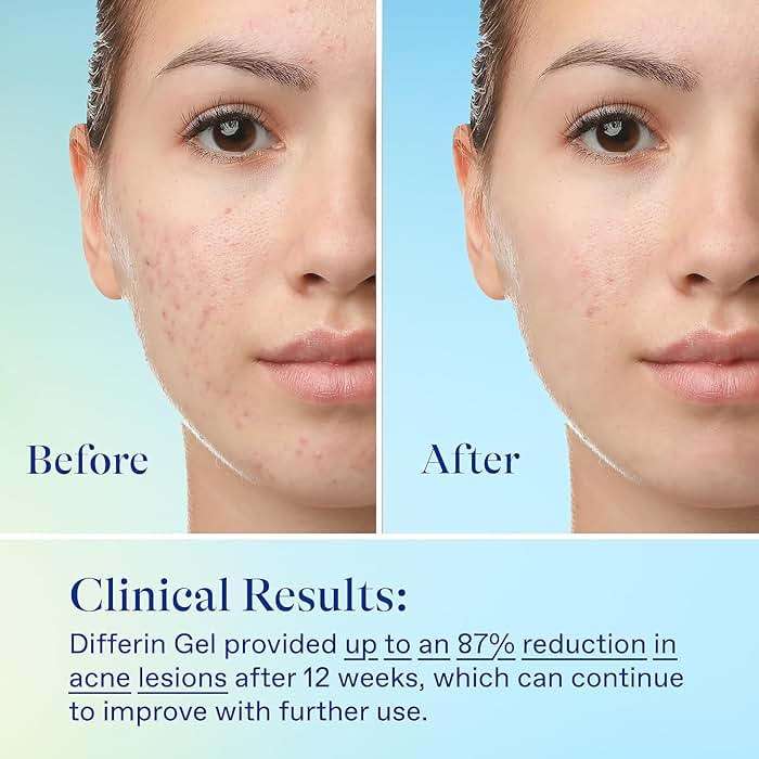 Differin Acne Skin Care Kit, Differin Gel Retinoid Acne Treatment for Face with 0.1% Adapalene & 5% Benzoyl Peroxide Face Wash & Body Wash, Designed for Pimple and Acne Prone Skin - Image 11