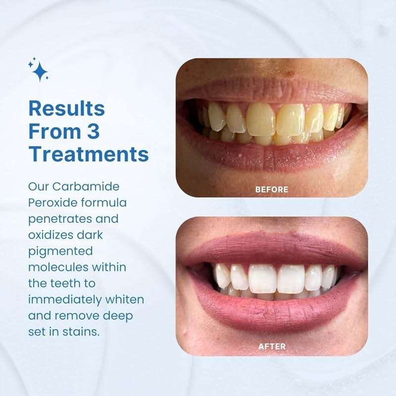 PurelyWHITE DELUXE Teeth Whitening Kit, Complete LED Teeth Whitening, 15+ Treatments, (3) 3ml Whitening Gel Syringes, Whiter Smile in 7 Minutes - Image 3