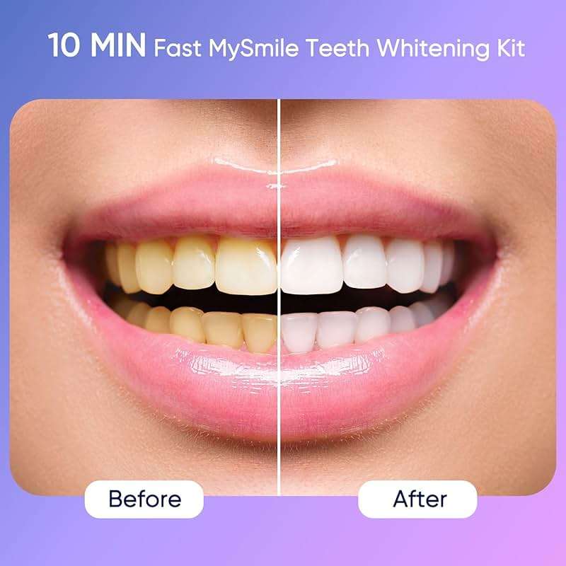 MySmile Deluxe 10 Min Teeth Whitening Kit with 28 LED Light, 35% Carbamide Peroxide Teeth Whitening Gel, Helps Remove Years of Stains from Coffee, Soda, Wines, Smoking, Food - Image 2