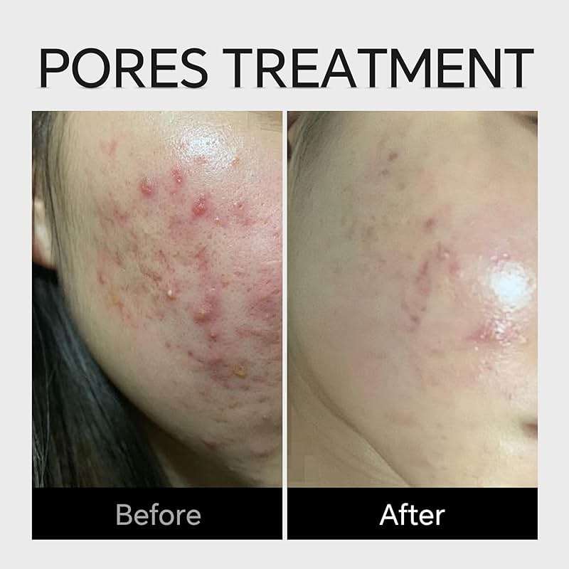 Azelaic Acid Serum Cream 10% Cystic Acne, Rosacea Treatment, Redness Relief, Hormonal Acne, Blemishes, Post-blemish Mark, Pore Refining, Sensitive Friendly Face & Back 1.59Oz - Image 3
