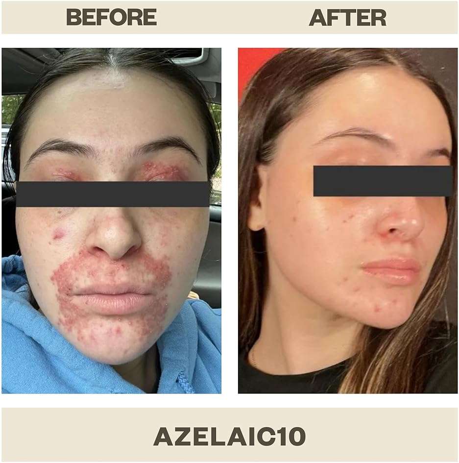 AziMD Skincare Azelaic10 | Azelaic Acid 10% Serum with Arbutin and Hyaluronic Acid - Image 4