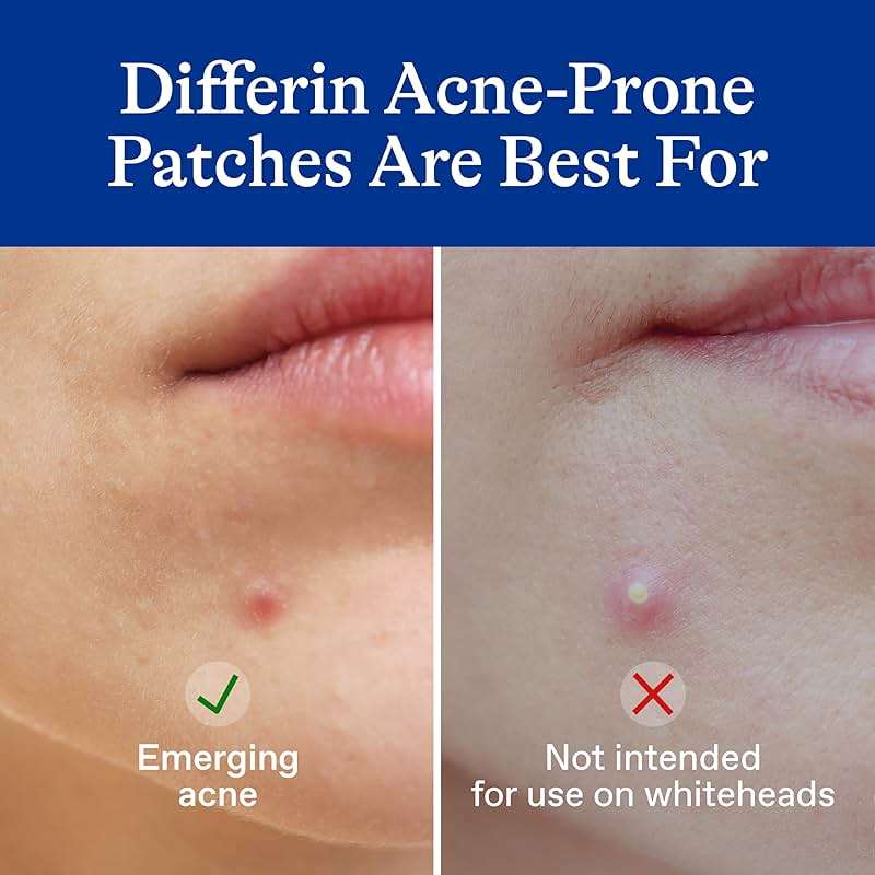 Differin Acne Patches, Pimple Patches for Acne Prone Skin, Formulated with Salicylic Acid and Centella, Fast Triple Action Power Patch for Day & Night, Dermatologist Tested, 36 Count - Image 4