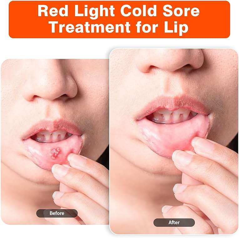 Red Light Cold Sore, Cold Sore Treatment Device, Red Light Therapy Wand for Cold Sore Lips Nose Face Hand, Target Skin Small Area - Image 4