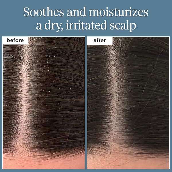 Briogeo Scalp Revival Rosemary Pre-Wash Oil | Moisturizing Scalp Treatment for Dry, Flaky, or Itchy Scalp | Strengthens Hair & Soothes Scalp | Vegan & Cruelty-Free - Image 2
