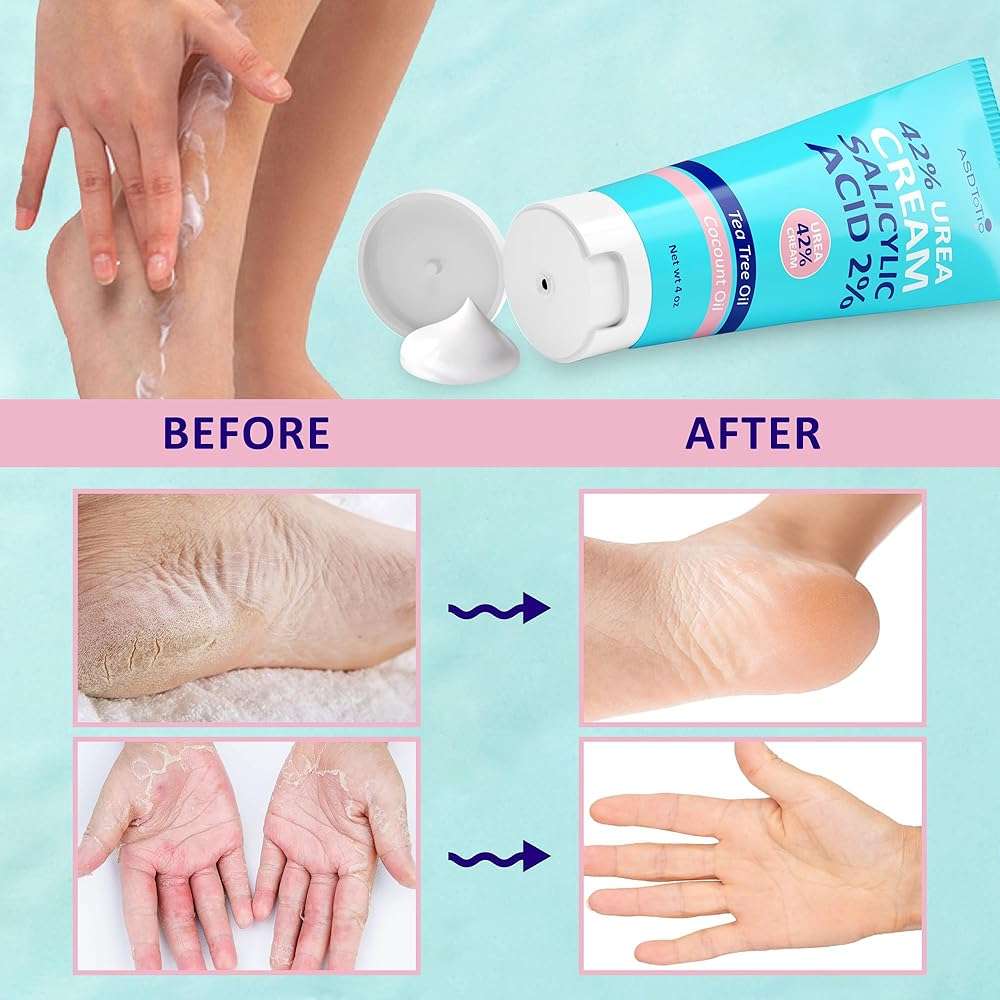 ASDToTio Urea Cream 42% - Foot Care for Dry Cracked Heels, Foot Lotion - With 2% Salicylic Acid, Tea Tree Oil, Shea Butter, Aloe Vera - For Feet, Hands, Heels, Elbows, Knees and More - 4 oz - Image 7