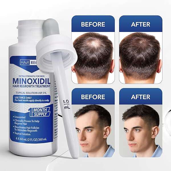 Hair Regen Liquid Minoxidil for Men 5% – Advanced Topical Solution for Regrowth – Growth Treatment for Men Hair Loss 6-Pack as 6-Month Supply Kit - Image 5