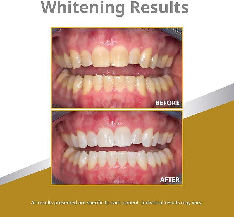 Opalescence 45% Syringes Teeth Whitening Gel - with PF - (8 Syringes) Refill Kit Carbamide Peroxide. Made by Ultradent, in Mint Flavor. Tooth Whitening 5359-4 - Image 4