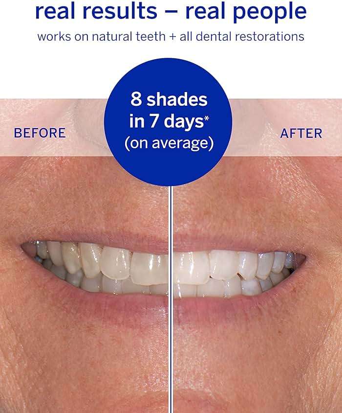 Supersmile Superstrips & Professional Whitening System Kit, Dissolving Teeth Whitening Strips Plus Toothpaste & Accelerator, Calprox®, Enamel Safe for Sensitive Teeth - Image 3