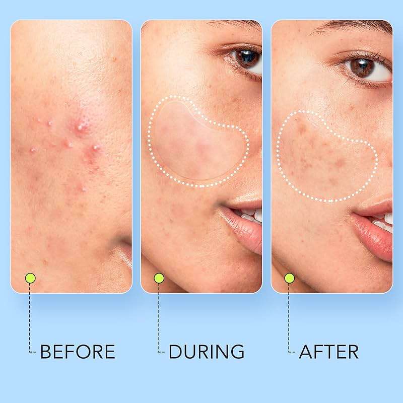 LitBear Large Pimple Patches (7 Sizes 112 Counts), Big Acne Patches, XL Hydrocolloid Bandages for Full Face, Forehead, Chin, Nose, Body, Back, Neck & Chest, Oval, Moon, Square hydrocolloid Patch - Image 4