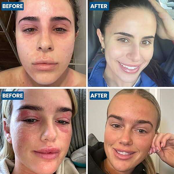 Grahams Natural Face & Eyelid Eczema Cream - Treatment for Eczema, Dermatitis, Itch Relief, Redness, Inflammation & Very Dry Skin - with Colloidal Oatmeal - Hypoallergenic & Steroid-Free (1 x 50g) - Image 7