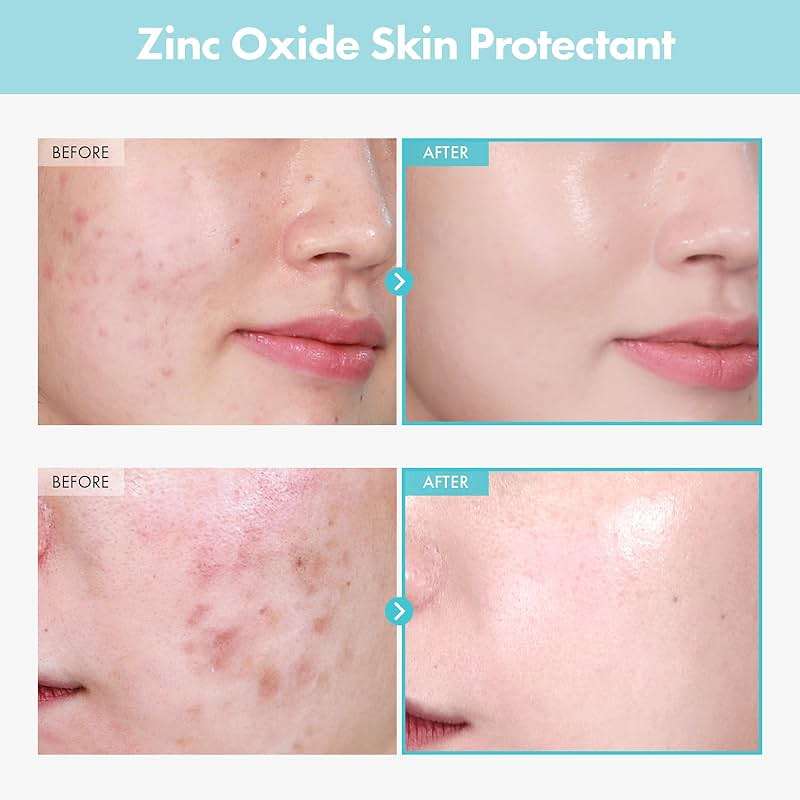 TOSOWOONG Zinc Oxide 10 Cream, 100,000ppm Zinc Oxide, Heal, Soothe Acne, Redness, Rosacea Treatment, Skin Barrier Repair, Moisture, Non-Comedogenic, Korean Skincare, 50g, 1.76 oz. - Image 2
