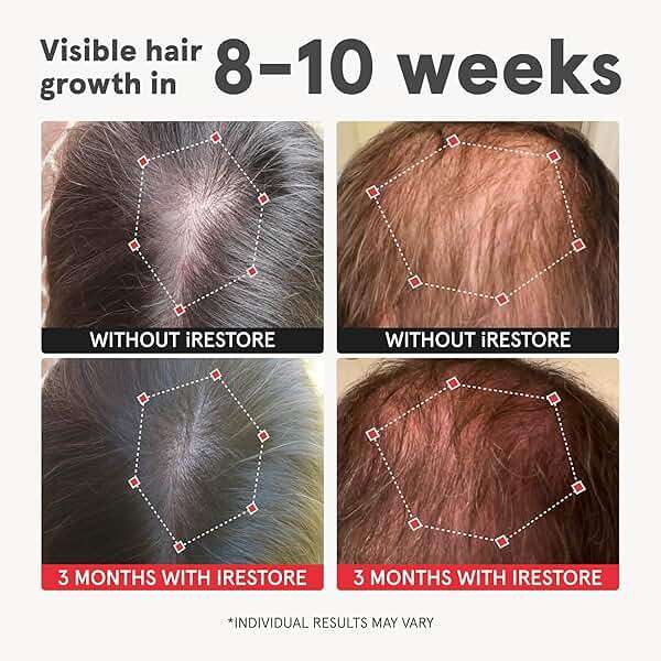 iRestore Advanced Hair Growth Supplement for Women with Lustriva, Hair Vitamins for Faster Hair Regrowth, Best for Hair Loss and Thinning, 1 Month Supply - 1 Count (Pack of 1) - Black - Image 2