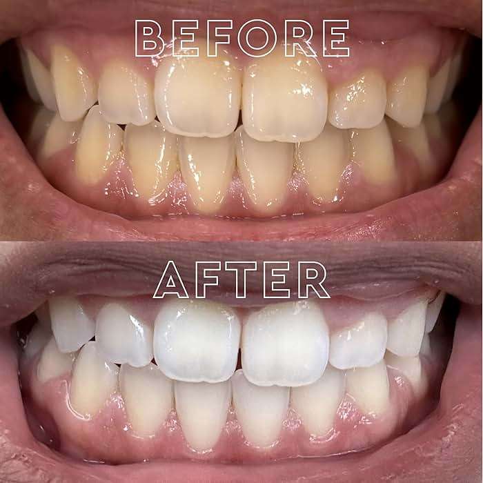 MOON Dissolving Teeth Whitening Strips, 28 Platinum Express No Rinse White Strips, Winter Mint, Hydrogen Peroxide & Essential Oils, Whiten Sensitive Teeth up to 8 Shades in 1 Week, Travel Essentials - Image 4