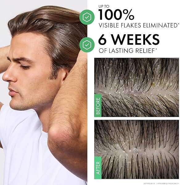 Vichy Dercos Dandruff Shampoo, Antifungal Itchy Scalp Treatment for Men & Women, Clinical Strength Selenium Sulfide, Formulated with Niacinamide & Salicylic Acid, Color Safe, Dermatologist Recommended - Image 4