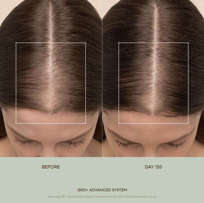 VEGAMOUR GRO+ Advanced Hair Serum | Improves Hair Density, Reduces Shedding and Promotes a Balanced Scalp | For Severe Signs of Thinning | Formulated Without Fragrance, Vegan, Cruelty-Free - Image 3