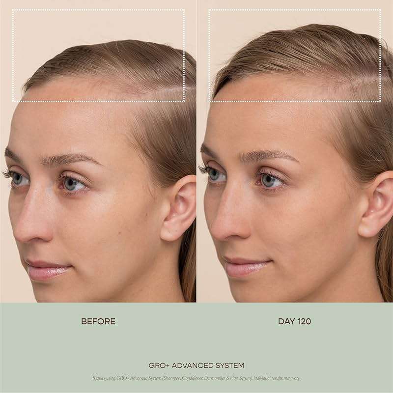 VEGAMOUR GRO+ Advanced Dermaroller | 1,200 Microneedle 0.25mm Scalp Tool | Gently Exfoliates the Scalp | Wide Head for Maximum Coverage - Image 2