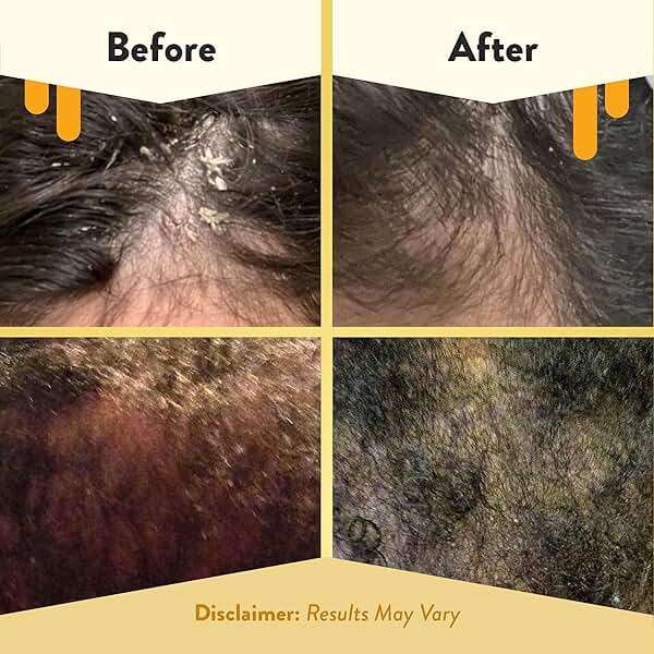 ECZEMA HONEY Scalp Kit - Natural Anti Dandruff Shampoo, Conditioner, & Scalp Oil for Flakes - Argan Oil & Tea Tree Oil for Hair - Eczema Treatment Helps Psoriasis, Seborrheic Dermatitis, & More - Image 4