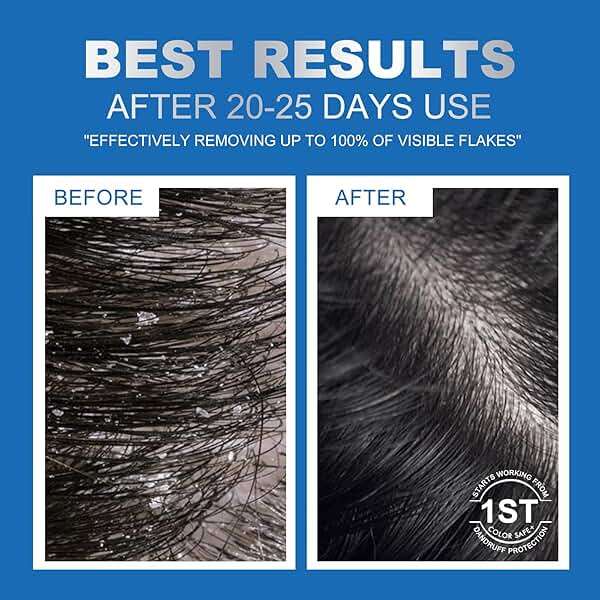Ceson&Cesun Anti-Fungal/Anti Dandruff 2 in 1 Shampoo for Folliculitis, Scalp Psoriasis & Seborrheic Dermatitis, Itchy & Dry Scalp Relief, Nourishes, Hydrates, Fresh Scent, Safe For Color-Treated Hair - Image 3
