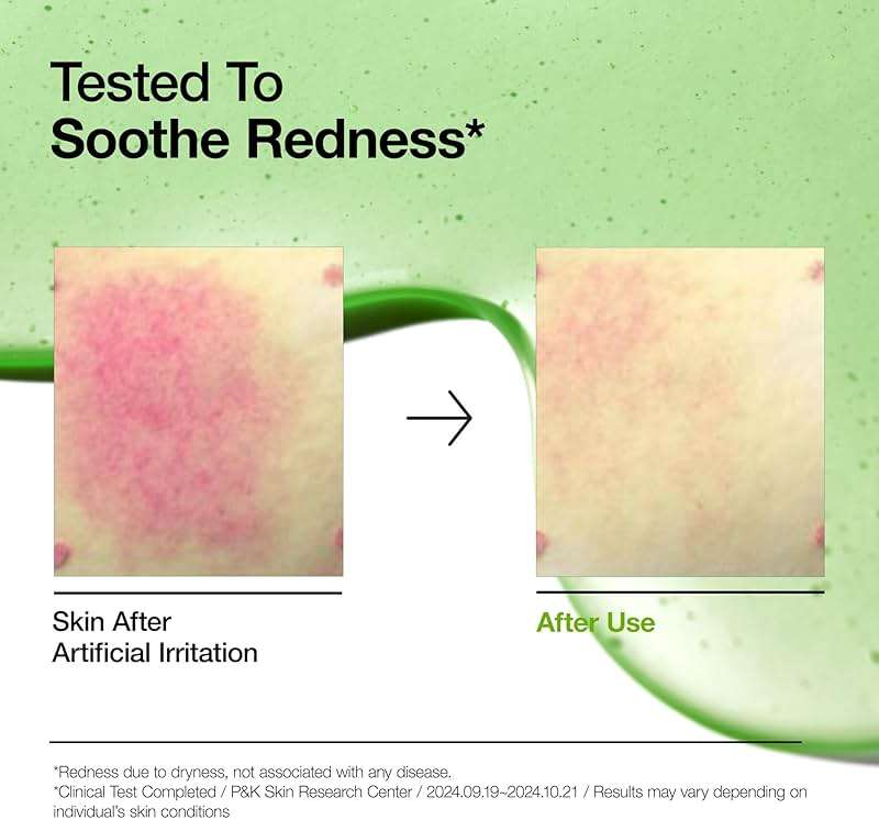 Anua Azelaic Acid 10 Hyaluron Redness Soothing Serum, Facial Serum for Blemish-Prone & Oily-Prone Skin, Lightweight & Hydrating Blemish Care, Hyaluronic Acid, Korean Skincare, 1.01 fl oz. - Image 3