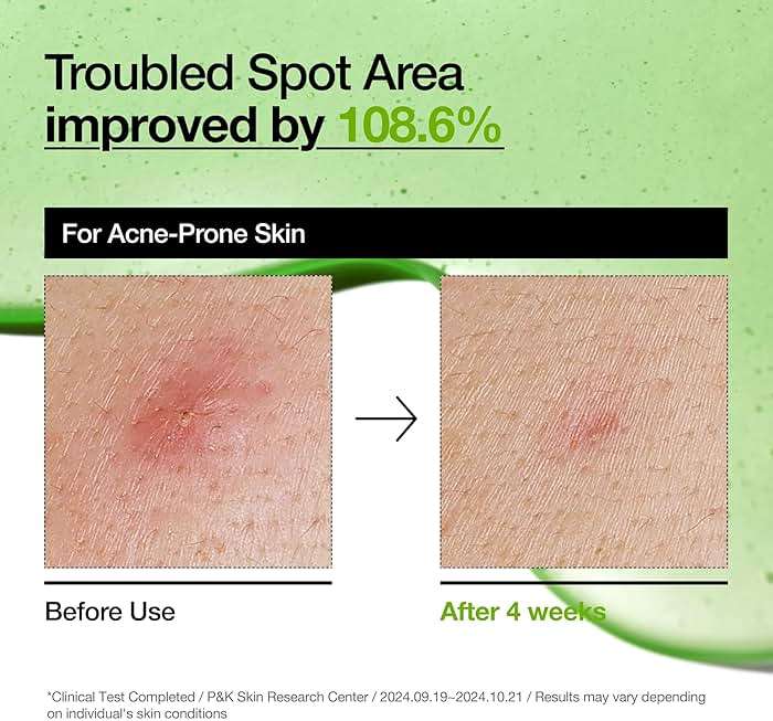 Anua Azelaic Acid 10 Hyaluron Redness Soothing Serum, Facial Serum for Blemish-Prone & Oily-Prone Skin, Lightweight & Hydrating Blemish Care, Hyaluronic Acid, Korean Skincare, 1.01 fl oz. - Image 5