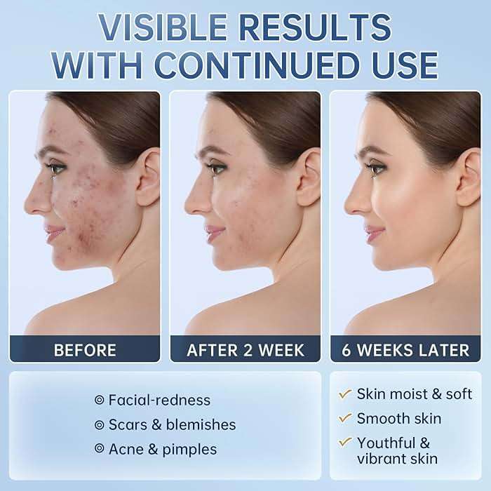 Azelaic Acid 14% Acne Cream for Redness Relief, Dark Spots, Facial Serum with Niacinamide & Vitamin C Prevent Acne Breakouts, Azelaic Acid Serum for Balance Excess Sebum & Soothe Irritation, 1 Oz. - Image 7