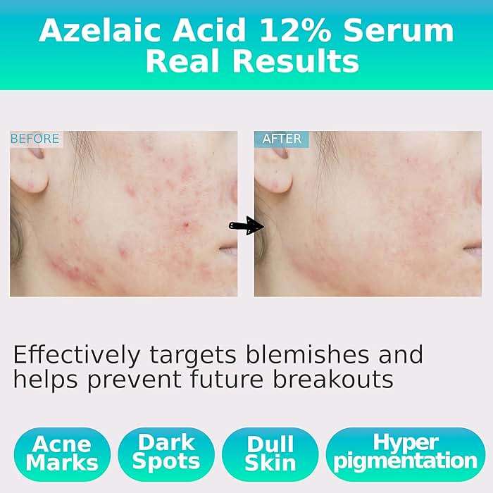 Azelaic Topical Acid 12% Serum for Face – Dark Spot Remover with Tranexamic Acid, Salicylic Acid, Niacinamide & Centella Asiatica – Acne, Hyperpigmentation & Rosacea Treatment 1 Oz Korean Skincare - Image 3