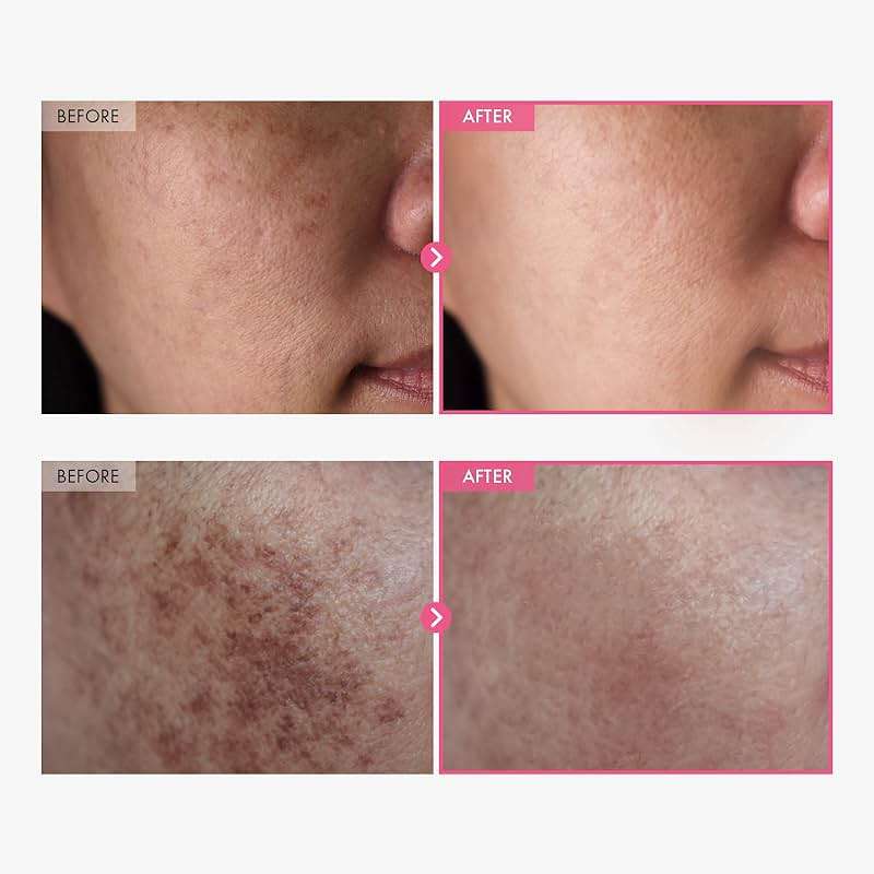 TOSOWOONG Arbutin 7% + Tranexamic Acid 4% Cream, 70,000ppm Arbutin, 40,000ppm TXA, Niacinamide, Glutathione, Dark Spots, Freckle, Blemishes, Pigmentation, Korean Skin Care, 50ml, 1.69 fl.oz. - Image 2