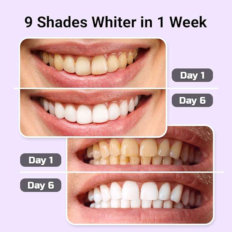 Puur Smile Teeth Whitening Kit – LED Light & Whitening Gel with Remineralization Syringes – Professional-Grade Whitening for Sensitive Teeth – Removes Stains from Coffee, Wine, & Smoking - Image 5