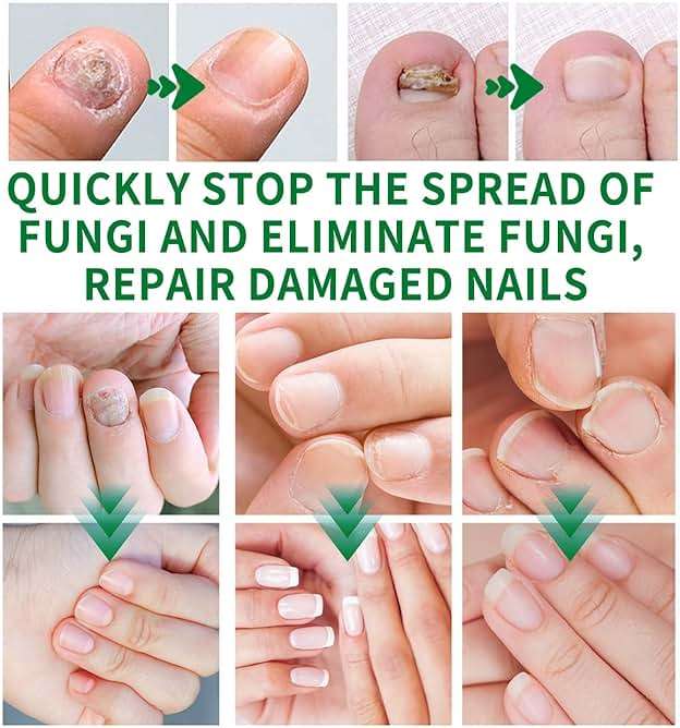 3Pcs Ginger Nail Treatment, 7days Nail Growth Serum Solution, Ginger Cuticle Care Oil for Nails Strengthener, Promote Nail Healthy Grow(30ml) - Image 5