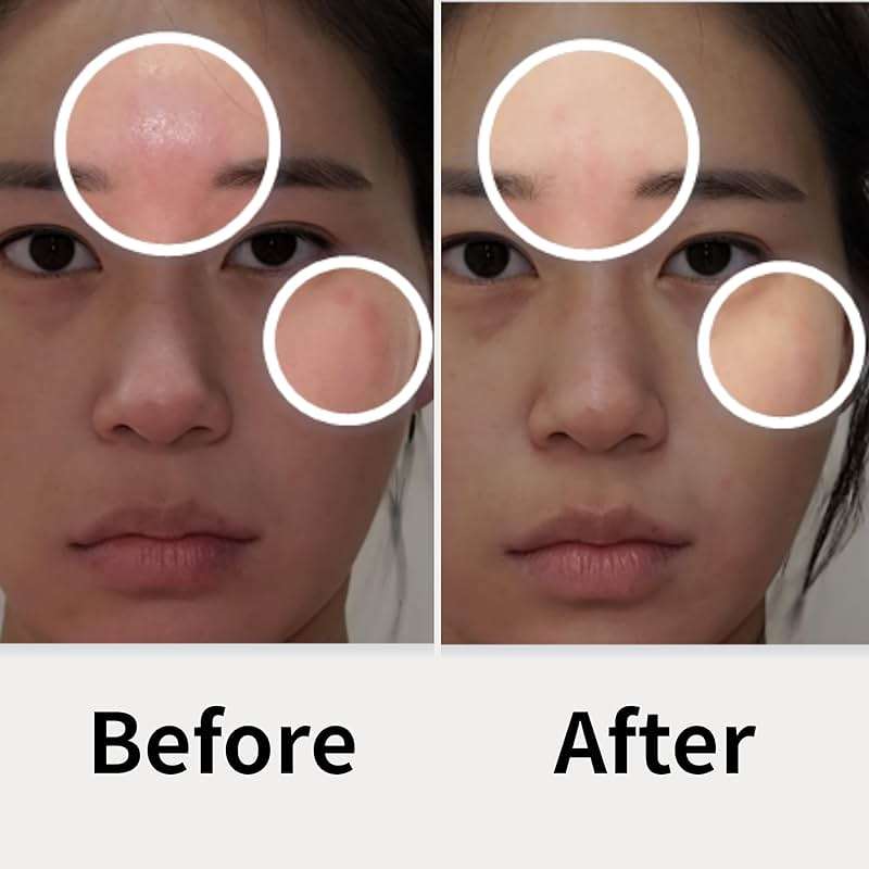 AD SOLUTION Ato Fast Calming Patch for Skin Redness, Itching & Flare-Ups – Soothing Hydrogel for Sensitive Skin with Cica & Panthenol – 10 Pairs - Image 2