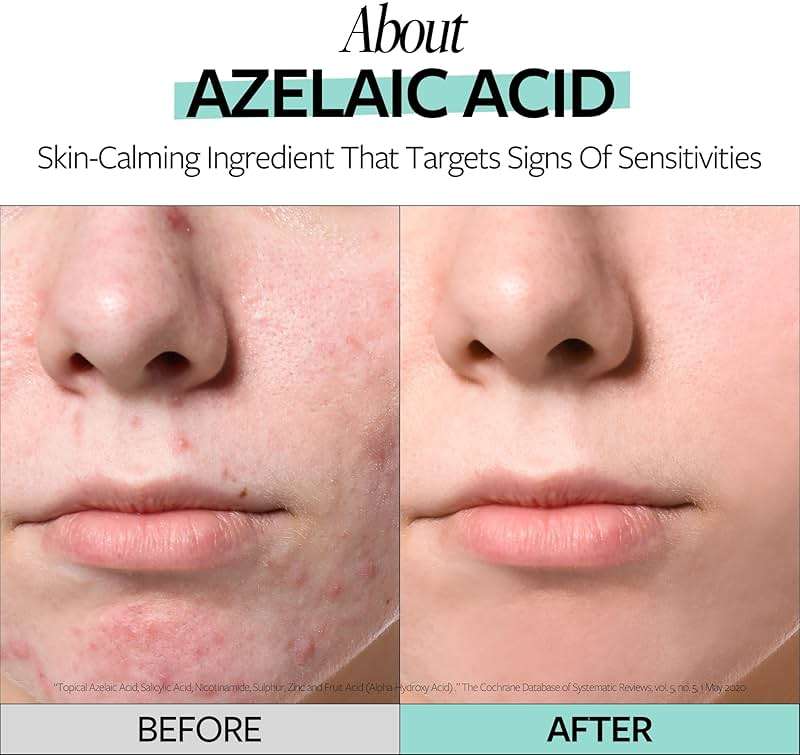 RECIPE Azelaic Acid 10 Soothing Ampoule - Soothing Serum, Facial Serum for Sensitive skin - Korean Skincare for Mild Breakouts (1.01 fl oz) - Image 4