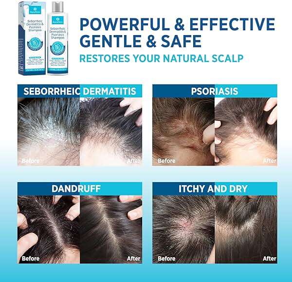 Seborrheic Dermatitis & Psoriasis Cream, Shampoo and Conditioner Set - Scalp Therapy System for Folliculitis, Psoriasis, Dandruff, Dry Scalp - Scalp Treatment to Relieve Itching, Flaking, Irritation - Image 3