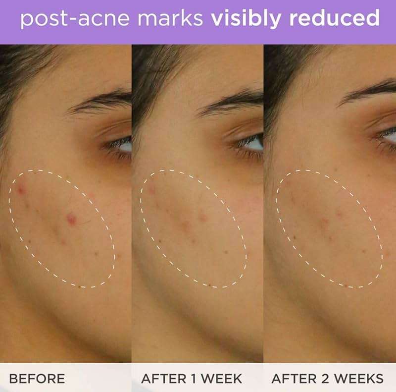 The Brightening Serum | Vitamin C Treatment for Brighter, Firmer Skin – Targets Hyperpigmentation & Fades Post-Acne Marks, 30 ml / 1.0 fl. oz. - Image 5