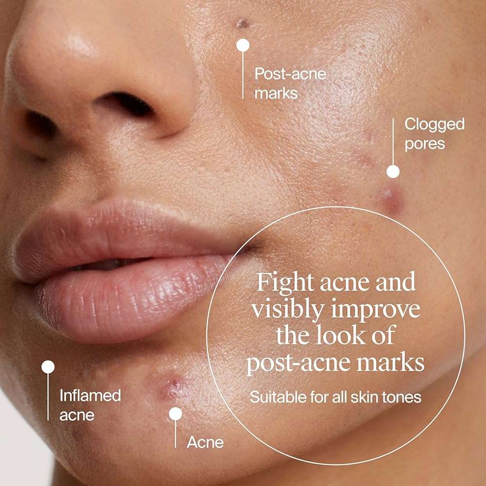 Neutrogena Evenly Clear Retinoid Adapalene Gel 0.1% Acne Spot Treatment, Once-Daily Topical Retinoid Helps Clear Breakouts & Visible Improvement in the Appearance of Post-Acne Mark, 0.5 oz - Image 3