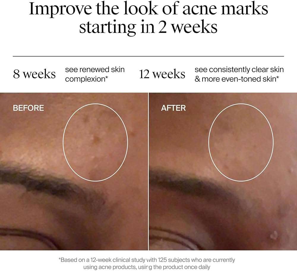 Neutrogena Evenly Clear Retinoid Adapalene Gel 0.1% Acne Spot Treatment, Once-Daily Topical Retinoid Helps Clear Breakouts & Visible Improvement in the Appearance of Post-Acne Mark, 0.5 oz - Image 5