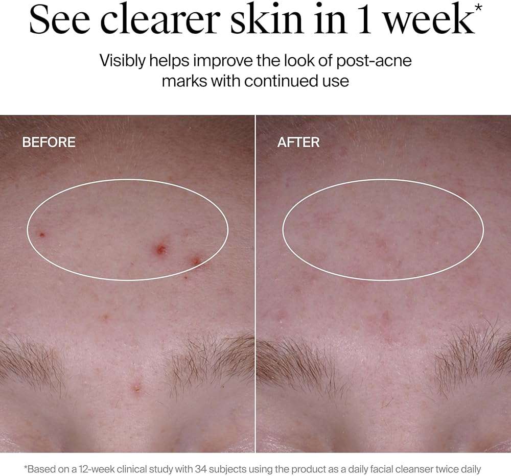 Neutrogena Evenly Clear Acne Cleanser with 2% Salicylic Acid & 2% PHA Exfoliant, Gentle Foaming Face Wash Clears Clogged Pores & Blackheads While Visibly Fading Look of Post-Acne Marks, 9.1 fl. oz - Image 6
