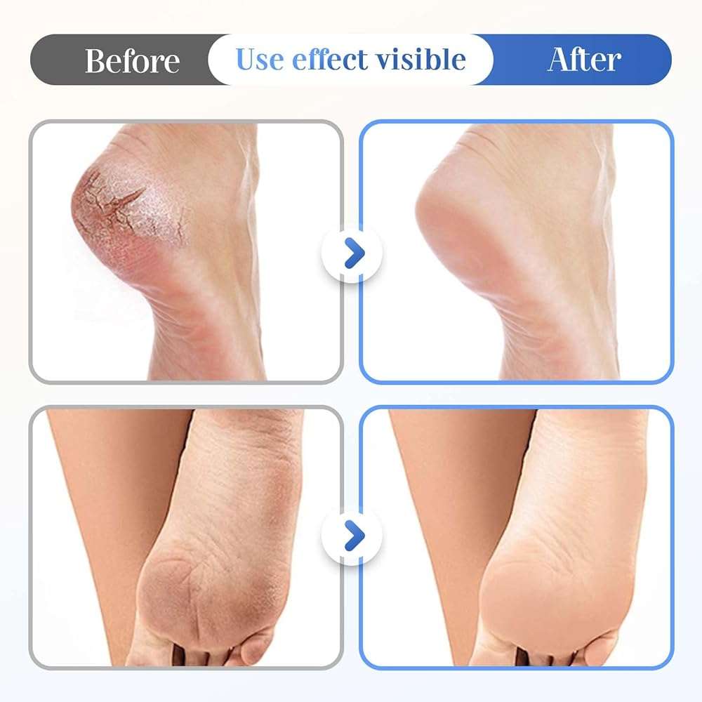 YAWOTA Hydrating and Anti-Cracking Foot Cream, Hydrating and Anti-Cracking Foot Cream for Dry Cracked Feet Knees Elbows Hands Hydrates, Smoothing Skin Women and Men (1) - Image 7