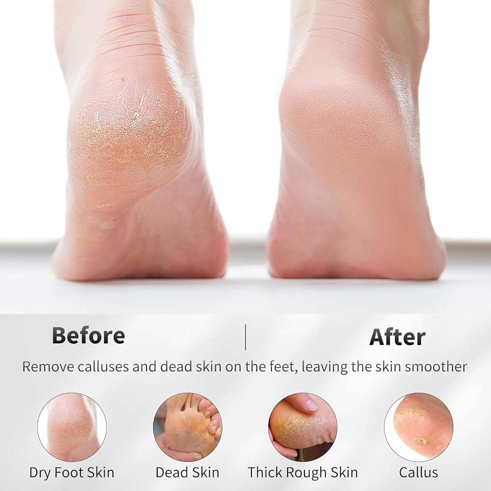 ÖkoStamm 4 PCS Natural Volcanic Pumice Stone for Feet - Rough Feet Scrubber with Hanging Rope for Dead Skin Removal, Pedicure Exfoliation Tool Use for Feet, Elbows, Knees - Image 4