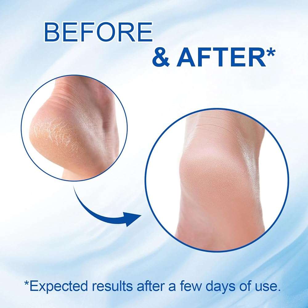 60% Urea Foot Cream Stick with 2% Salicylic Acid - Maximum Strength for Dry Cracked Heels & Calluses, Rapidly Softens Thick Skin, Exfoliates Dead Skin, Portable & Non-Greasy, 2-Day Visible Results - Image 2