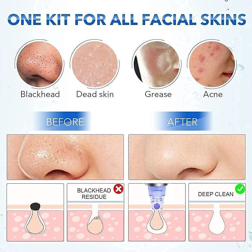 JPNK Blackhead Remover Tool Comedones Extractor Acne Removal Kit for Blemish, Whitehead Popping, 6 Pcs Zit Removing for Nose Face Tools with a Leather Bag - Image 3