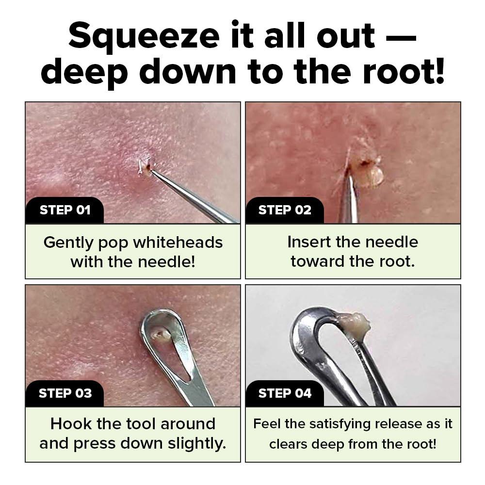 I DEW CARE Dual-Tip Pimple Tool - Proper Popper | Blackhead Remover, Blemish Exfoliating, Professional Acne Squeezer, Comedone Zit Extractor for Women, 2in1 Stainless Steel Lancet, 1ea - Image 3