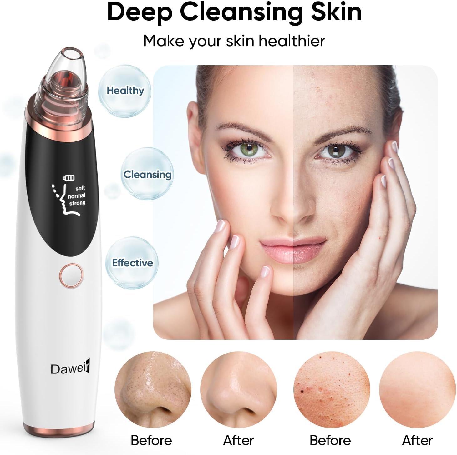 Blackhead Remover Vacuum - Black Head Remover for Face, Blackhead Extractor Tool with 65kPa Suction, 5 Tips & 3 Levels, USB Rechargeable Pore Vacuum Cleaner for All Skin Types (White) - Image 2