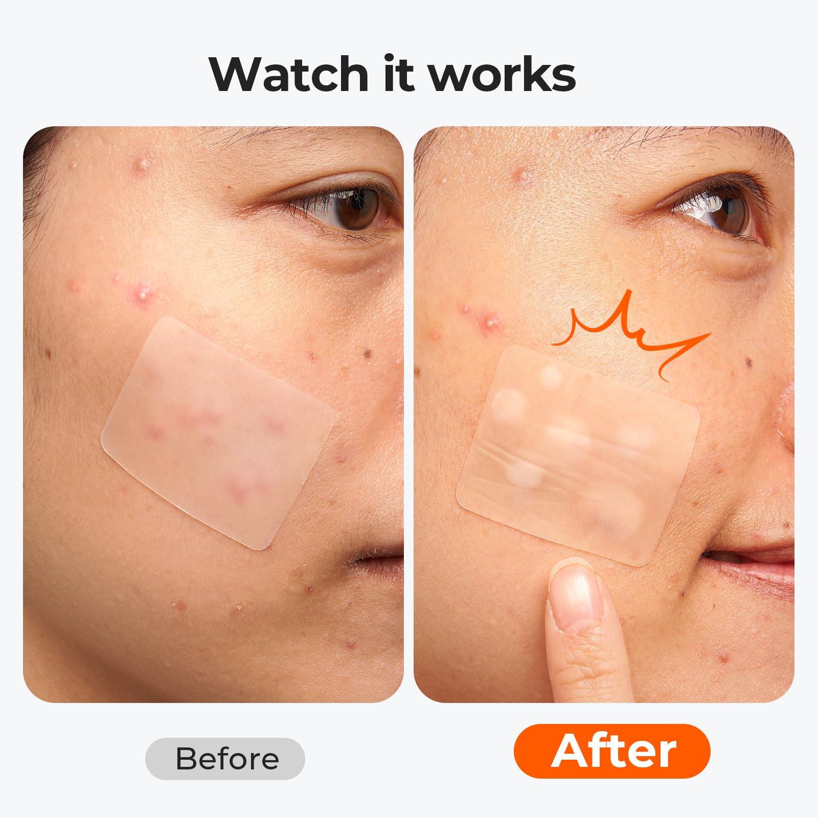 TKTK Large Pimple Patches (5 Sizes, 92 Patches), Hydrocolloid Acne Patches, XL Zit Patches for Face, Forehead, Chin, Nose, Body, Back, Chest, Rectangular, Square, and Dot Hydrocolloid Bandages - Image 7