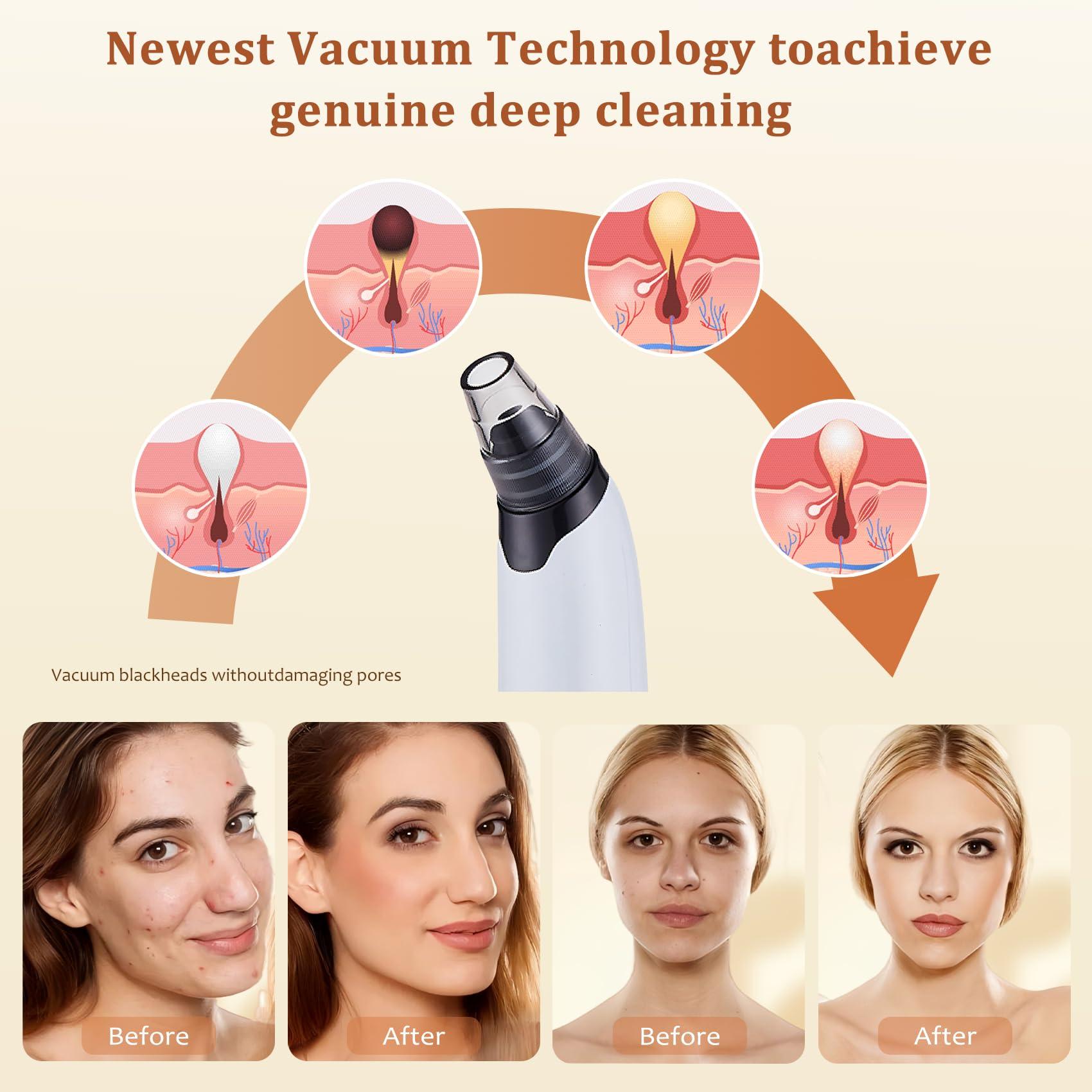 Blackhead Remover Vacuum - Powerful Pore Vacuum for Cleansing, Blackhead Extractor with 3 Adjustable Suction Levels, 4 Blackhead Removal Tools, USB Rechargeable，Suitable for Women and Men - Image 3