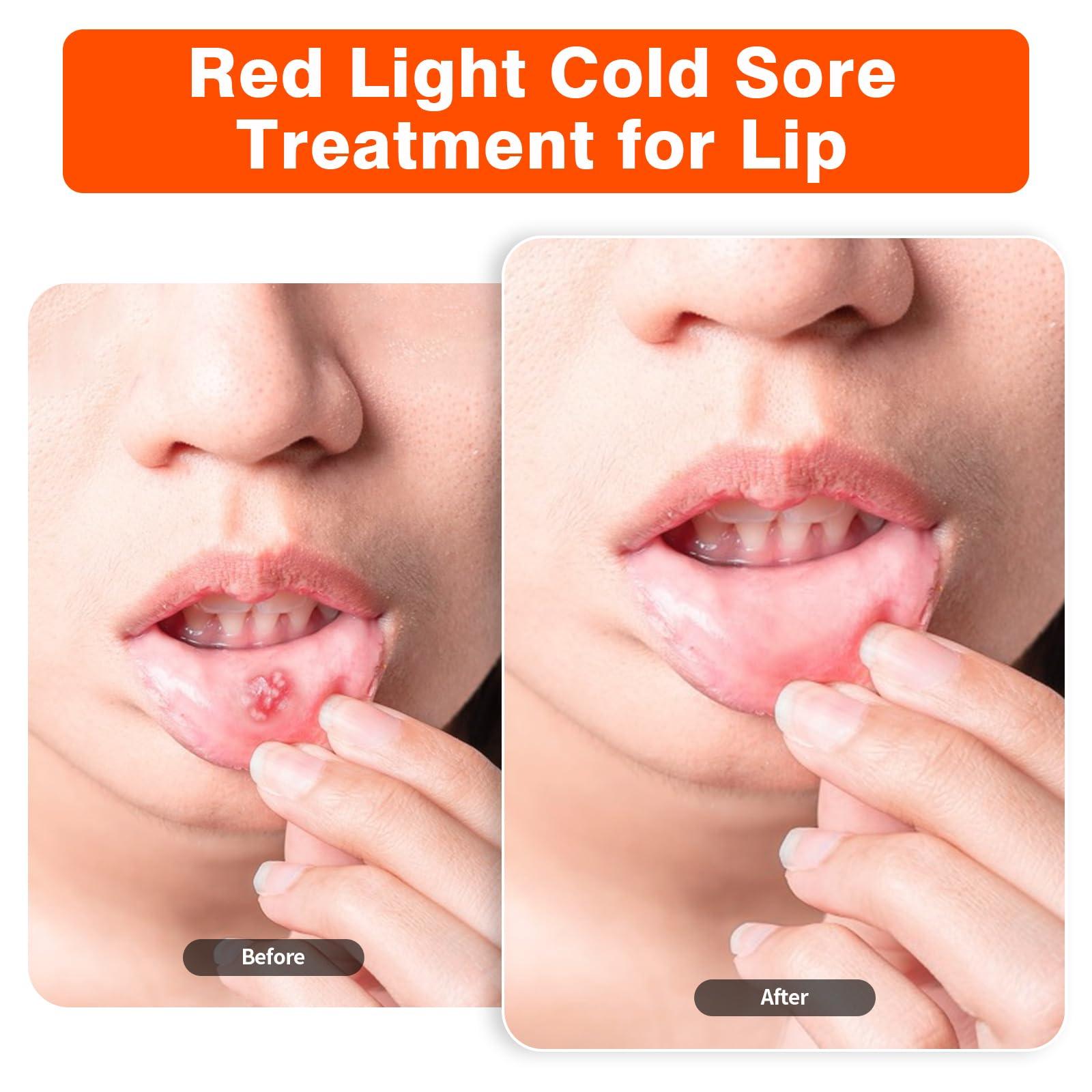 Red Light Cold Sore, Cold Sore Treatment Device, Red Light Therapy for Cold Sore Lips Nose Face Hand, Target Skin Small Area - Image 4
