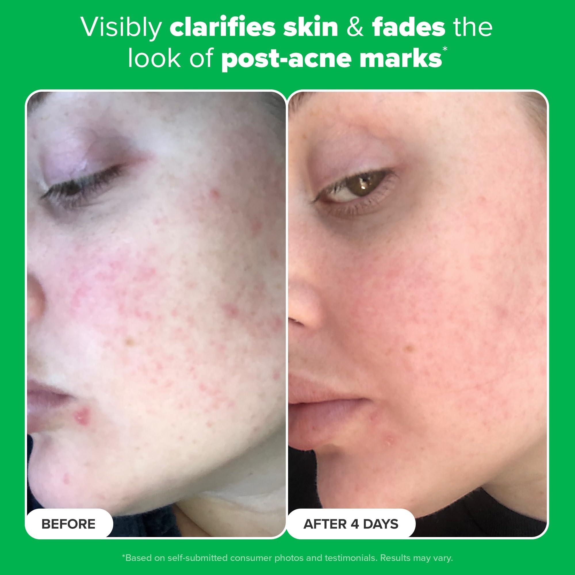 Paula's Choice BOOST 10% Azelaic Acid Booster Cream Gel, Licorice Extract & Salicylic Acid, Oil-Free Skin Brightening Serum - Image 5